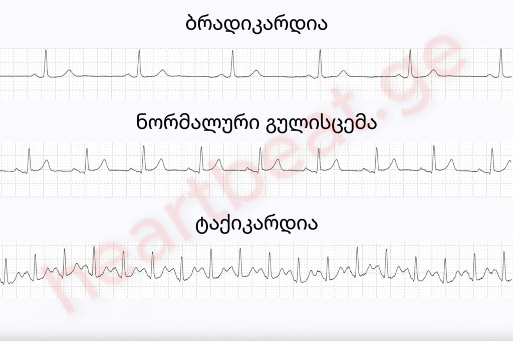არითმია, ბრადიკარდია, ტაქიკარდია