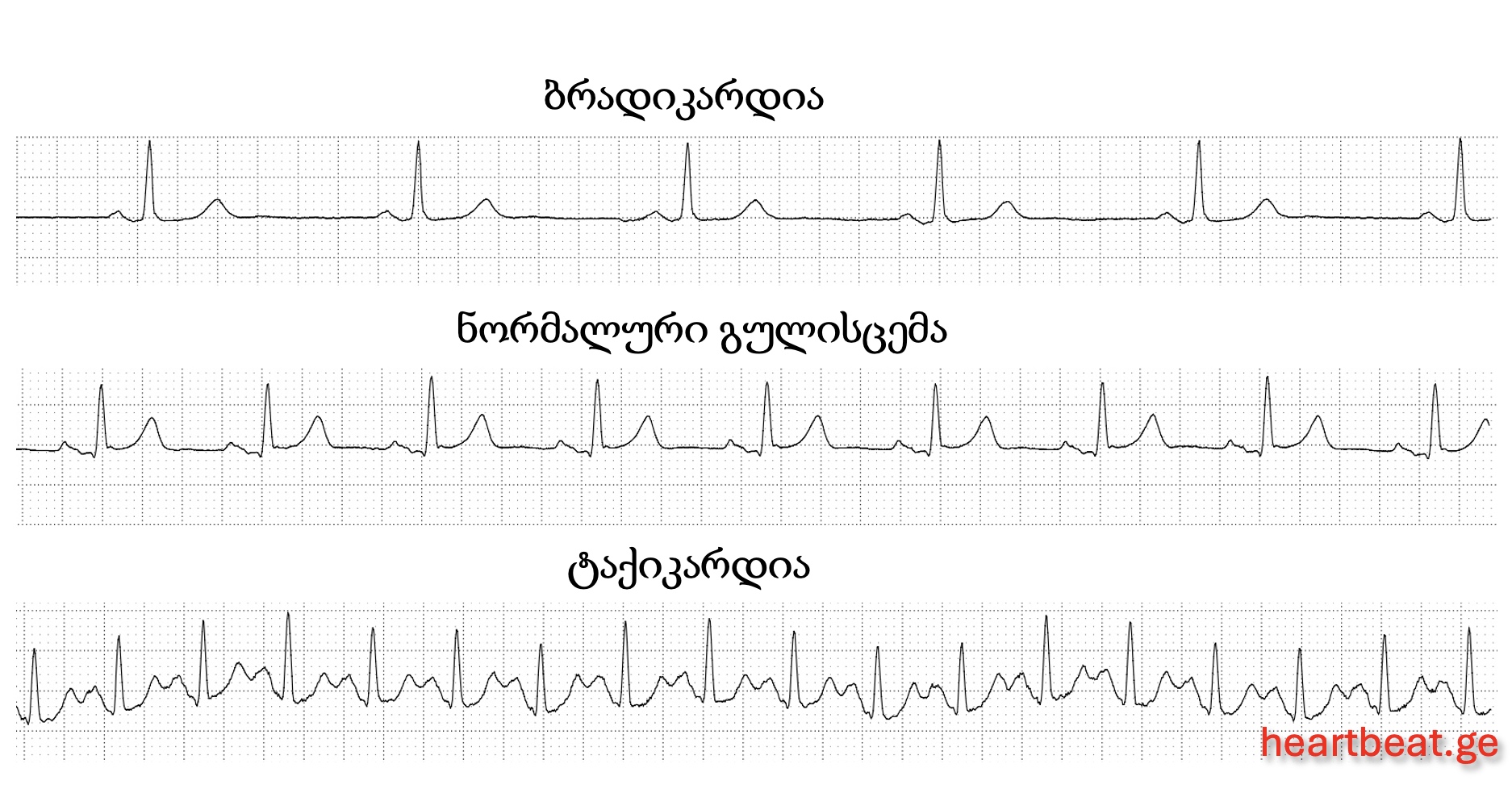 არითმია, ბრადიკარდია, ტაქიკარდია